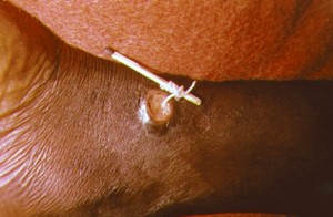 Extracción de un gusano de Guinea con una cerilla.