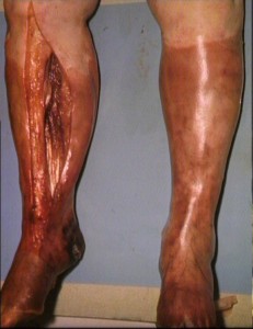Individuo afectado por gangrena. Así muestra la enfermedad tras un tratamiento en cámara hiperbárica.