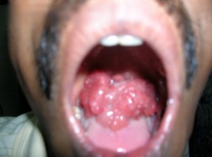 Imagen de un paciente afectado por rinosporidiosis. Obsérvense las masas de "pólipos" en la cavidad orofaríngea del sujeto.