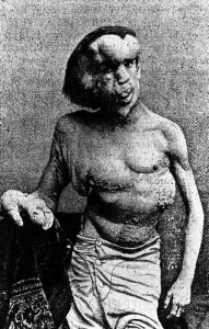 Imagen tomada de Joseph Merrick, primer caso descrito de afectado por síndrome de Proteus.