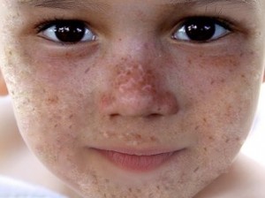 Cara de un infante que muestra claros síntomas de queratosis facial, propia del síndrome de Cowden.